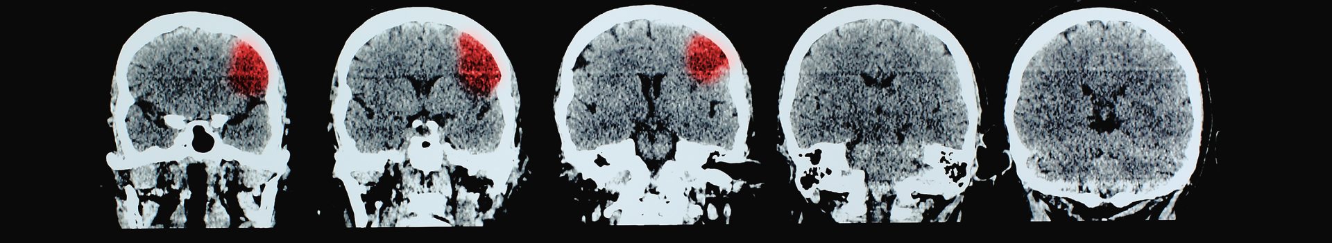Brain CT showing stroke